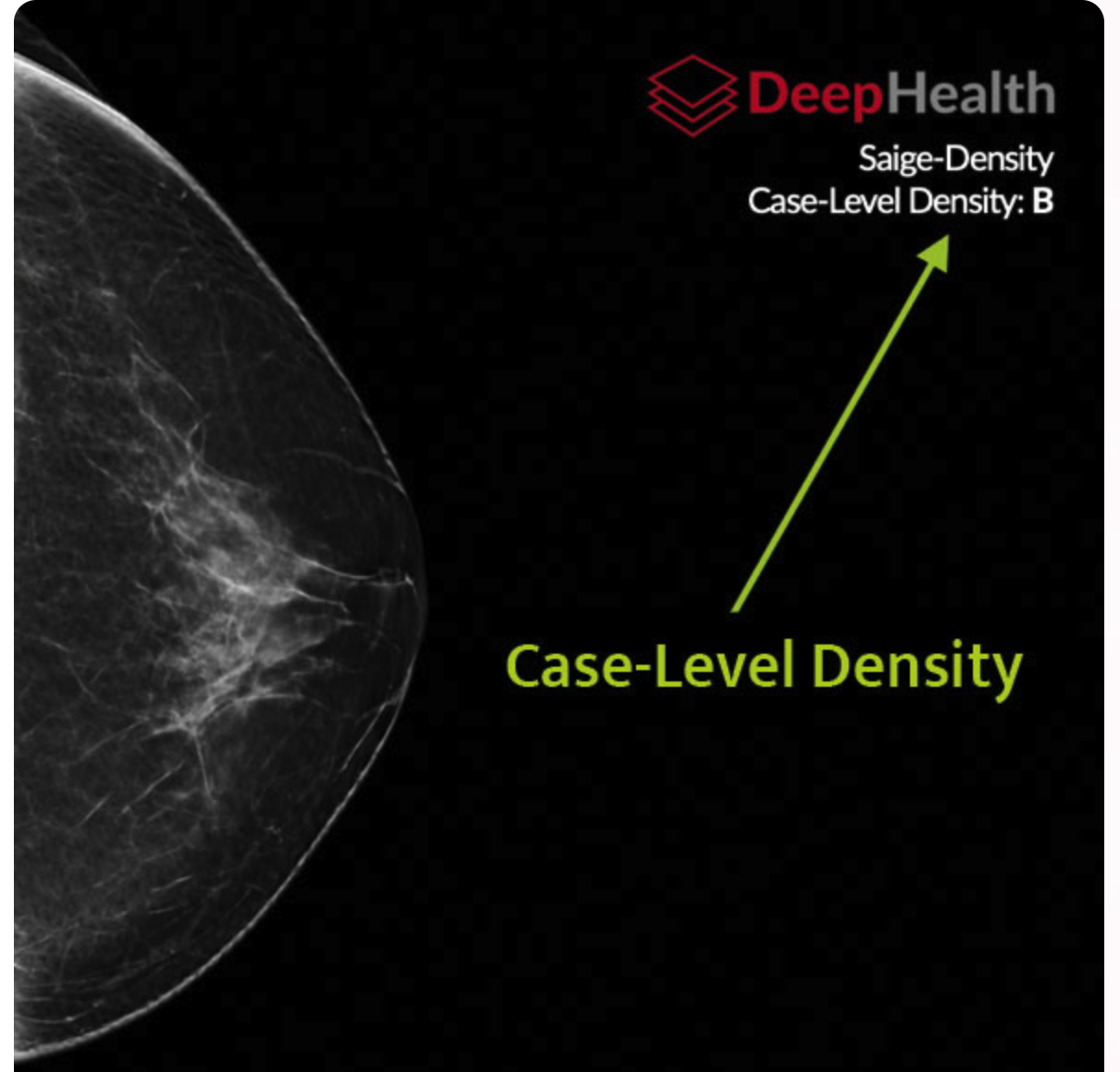 DeepHealth Nets FDA Clearance Of Its Third AI Mammography Product ...